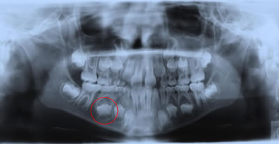 ortopantomografia di un bambino