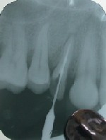 una radiografia endorale