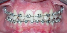un apparecchio ortodontico fisso