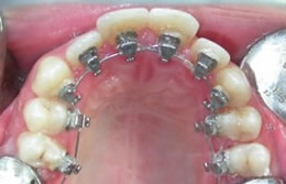 brackets per l'ortodonzia linguale
