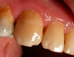 ricostruzione di due denti cariati